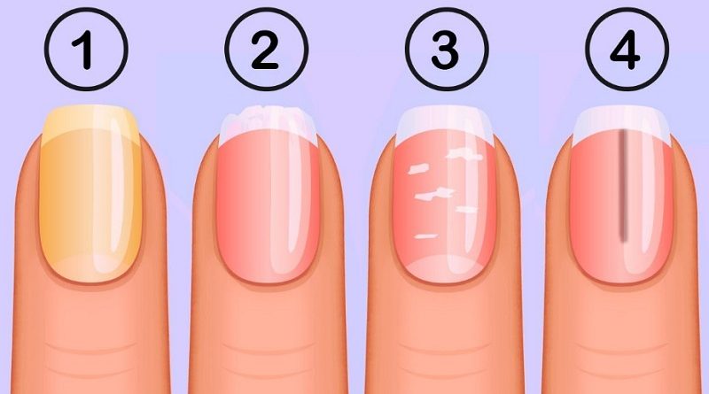 What Your Nails Say About Your Healt