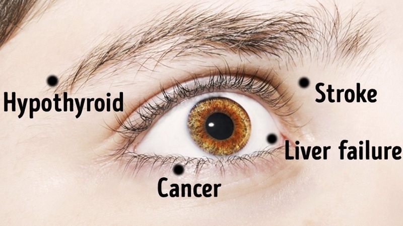 6 Things Your Eyes Are Trying to Tell You About Your Health